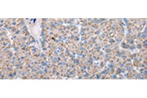 Immunohistochemistry of paraffin-embedded Human liver cancer tissue using FKBPL Polyclonal Antibody at dilution of 1:50(x200) (FKBPL 抗体)