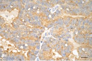 Immunohistochemistry was performed on paraffin-embedded human endometrial carcinoma using glutathione peroxidase 4 antibody (ABIN7798753), 1:200). (Recombinant GPX4 抗体)
