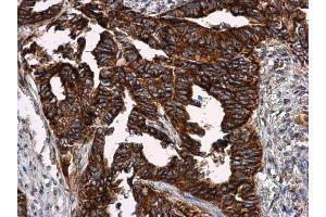 IHC-P Image VCAM1 / CD106 antibody detects VCAM1 / CD106 protein at cell membrane in human cervical carcinoma by immunohistochemical analysis. (VCAM1 抗体)