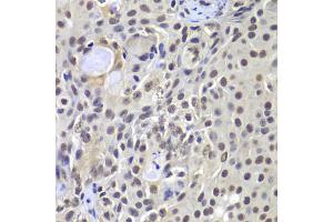 Immunohistochemistry of paraffin-embedded human well-differentiated squamous skin carcinoma using PRKDC antibody (ABIN5975861) at dilution of 1/100 (40x lens). (PRKDC 抗体)