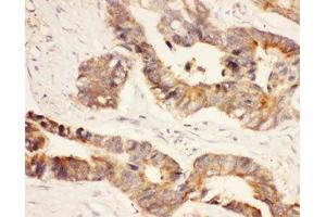 IHC-P: HSP90 antibody testing of human intestinal cancer tissue (HSP90AA1 抗体  (AA 2-365))