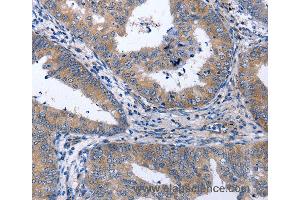Immunohistochemistry of Human thyroid cancer using NPPB Polyclonal Antibody at dilution of 1:40 (NPPB 抗体)