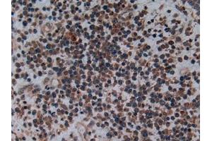 Detection of C2CD3 in Human Skin cancer Tissue using Polyclonal Antibody to C2 Calcium Dependent Domain Containing Protein 3 (C2CD3) (C2CD3 抗体  (AA 1432-1647))