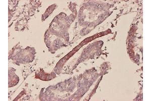 Immunoperoxidase of monoclonal antibody to SAA1 on formalin-fixed paraffin-embedded human colon adenocarcinoma tissue. (SAA1 抗体  (AA 1-122))