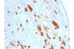 Formalin-fixed, paraffin-embedded human Mesothelioma stained with Calretinin Mouse Monoclonal Antibody (CALB2/2807). (Calretinin 抗体  (AA 23-242))
