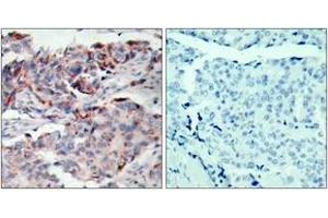 Immunohistochemistry analysis of paraffin-embedded human breast carcinoma, using JAK2 (Phospho-Tyr221) Antibody. (JAK2 抗体  (pTyr221))