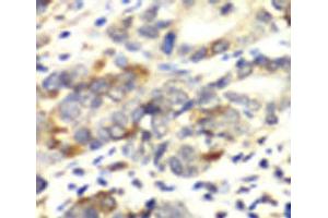 Immunohistochemistry of paraffin-embedded Human colon carcinoma using APLP1 Polyclonal Antibody at dilution of 1:100 (40x lens). (APLP1 抗体)