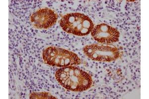 IHC image of ABIN7127518 diluted at 1:100 and staining in paraffin-embedded human colon cancer performed on a Leica BondTM system. (Recombinant GPA33 抗体)