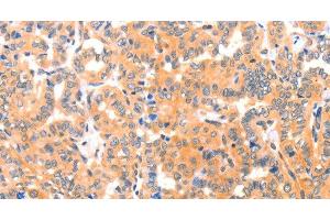 Immunohistochemistry of paraffin-embedded Human thyroid cancer tissue using THBS1 Polyclonal Antibody at dilution 1:60 (Thrombospondin 1 抗体)