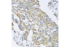 Immunohistochemistry of paraffin-embedded human lung cancer using SLC25A13 antibody.