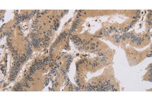 Immunohistochemistry of paraffin-embedded Human colon cancer tissue using ITIH1 Polyclonal Antibody at dilution of 1:30 (ITIH1 抗体)
