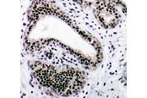 IHC-P: NRF1 antibody testing of human breast cancer tissue (NRF1 抗体  (Middle Region))