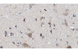 ABIN6272876 at 1/100 staining Human brain cancer tissue by IHC-P. (IFT81 抗体)