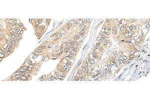 Immunohistochemistry of paraffin-embedded Human gastric cancer tissue using TBCB Polyclonal Antibody at dilution of 1:25(x200) (TBCB 抗体)