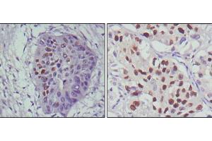 Immunohistochemical analysis of paraffin-embedded human esophageal cancer (left) and lung cancer (right), showing nuclear localization using p53 mouse mAb with DAB staining. (p53 抗体)