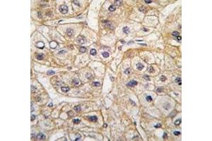 IHC analysis of FFPE human hepatocarcinoma tissue stained with the EGF Receptor antibody