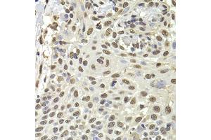 Immunohistochemistry of paraffin-embedded human well-differentiated squamous skin carcinoma using PUF60 antibody. (PUF60 抗体)