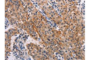 The image on the left is immunohistochemistry of paraffin-embedded Human lung cancer tissue using ABIN7128260(ADH1A Antibody) at dilution 1/20, on the right is treated with fusion protein. (ADH1A 抗体)