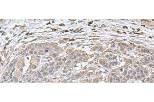 Immunohistochemistry of paraffin-embedded Human esophagus cancer tissue using NEUROG3 Polyclonal Antibody at dilution of 1:70(x200) (Neurogenin 3 抗体)