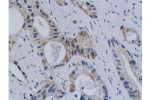 Formalin-fixed and paraffin embedded human colon labeled with Anti Styk1 Polyclonal Antibody, Unconjugated  followed by conjugation to the secondary antibody and DAB staining (STYK1 抗体  (AA 51-150))