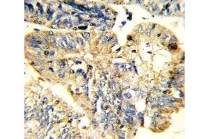IHC analysis of FFPE human colon carcinoma stained with LIF antibody (LIF 抗体  (AA 72-101))