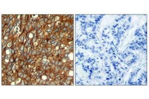 Immunohistochemical analysis of paraffin-embedded human breast carcinoma tissue using HER2 (Phospho-Tyr1248) Antibody (left) or the same antibody preincubated with blocking peptide (right). (ErbB2/Her2 抗体  (pTyr1248))