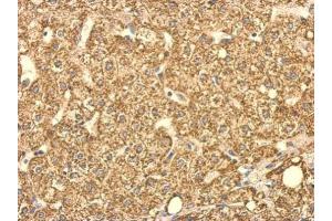 IHC-P Image SUCLG2 antibody detects SUCLG2 protein at cytosol on human hepatoma by immunohistochemical analysis. (SUCLG2 抗体)