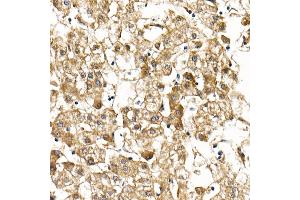Immunohistochemistry of paraffin-embedded human liver cancer using Smad9 Rabbit pAb (ABIN6132668, ABIN6148096, ABIN6148097 and ABIN6223425) at dilution of 1:100 (40x lens). (SMAD9 抗体  (AA 1-300))