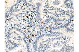 ABIN6264995 and ABIN6273073 at 1/100 staining Human lung cancer by IHC-P. (Septin 9 抗体  (C-Term))