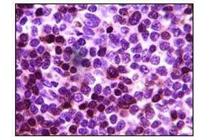 Immunohistochemical analysis of paraffin-embedded human lymph tumor, showing cytoplasmic localization using ZAP70 mouse mAb with DAB staining (ZAP70 抗体)