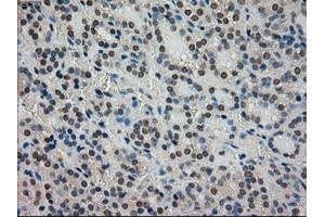 Immunohistochemical staining of paraffin-embedded Carcinoma of thyroid tissue using anti-STK39mouse monoclonal antibody. (STK39 抗体)