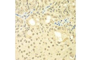 Immunohistochemistry of paraffin-embedded human oophoroma using TBL1XR1 antibody at dilution of 1:100 (x400 lens). (TBL1XR1 抗体)
