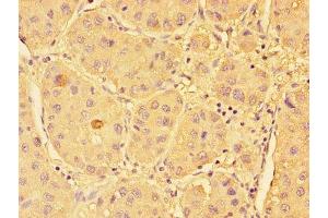 Immunohistochemistry of paraffin-embedded human liver cancer using ABIN7170581 at dilution of 1:100 (SPHK1 抗体  (AA 1-384))