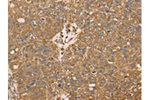 The image on the left is immunohistochemistry of paraffin-embedded Human breast cancer tissue using ABIN7130945(RRBP1 Antibody) at dilution 1/25, on the right is treated with fusion protein. (RRBP1 抗体)