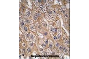 Formalin-fixed and paraffin-embedded human hepatocarcinoma tissue reacted with Endophilin B1 Antibody (Y80) (ABIN392590 and ABIN2842121) , which was peroxidase-conjugated to the secondary antibody, followed by DAB staining. (SH3GLB1 抗体  (AA 59-86))
