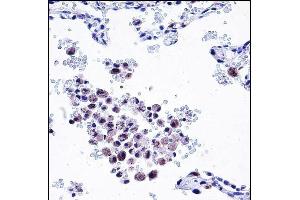 ARHGDIB Antibody (C-term) (ABIN657665 and ABIN2846658) immunohistochemistry analysis in formalin fixed and paraffin embedded human lung tissue followed by peroxidase conjugation of the secondary antibody and DAB staining. (ARHGDIB 抗体  (C-Term))