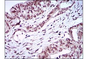 Immunohistochemical analysis of paraffin-embedded rectum cancer tissues using ZEB1 mouse mAb with DAB staining. (ZEB1 抗体  (AA 967-1108))