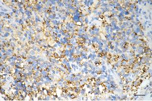Immunohistochemistry was performed on paraffin-embedded human glioblastoma using cytochrome b5 reductase 3 antibody (ABIN7798244), 1:200).