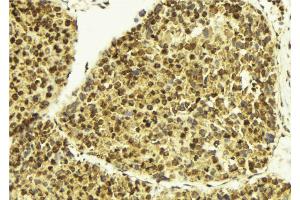 ABIN6273407 at 1/100 staining Human breast cancer tissue by IHC-P. (TSEN2 抗体  (Internal Region))