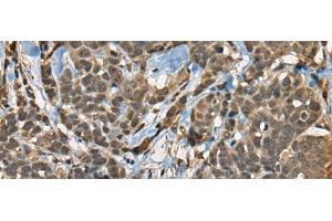 Immunohistochemistry of paraffin-embedded Human thyroid cancer tissue using CIR1 Polyclonal Antibody at dilution of 1:40(x200) (CIR1 抗体)