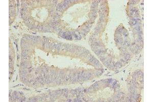 Immunohistochemistry of paraffin-embedded human endometrial cancer using ABIN7146467 at dilution of 1:100 (Calmegin 抗体  (AA 200-400))