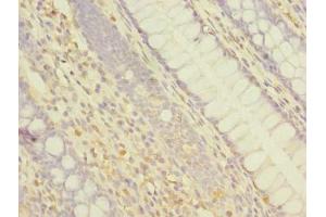 Immunohistochemistry of paraffin-embedded human colon cancer using ABIN7144926 at dilution of 1:100 (ABCF3 抗体  (AA 201-500))