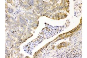 IHC testing of FFPE human intestinal cancer tissue with CD147 antibody at 1ug/ml. (CD147 抗体)