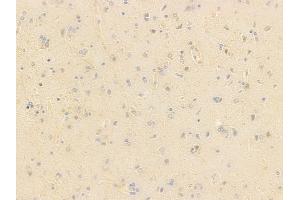 ABIN7096979 and ABIN7101046 at 1/100 staining human glioblastoma by IHC-P.