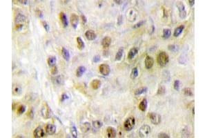 Immunohistochemical analysis of paraffin-embedded human breast cancer tissue using RORA polyclonal antibody .