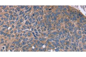 Immunohistochemistry of paraffin-embedded Human esophagus cancer tissue using RGS4 Polyclonal Antibody at dilution 1:30 (RGS4 抗体)
