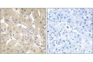 Immunohistochemistry analysis of paraffin-embedded human liver carcinoma tissue, using TNAP2 Antibody. (TNFAIP2 抗体  (AA 131-180))