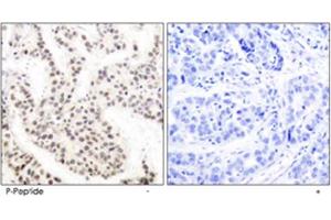 Immunohistochemical analysis of paraffin-embedded human breast carcinoma tissue using ELK1 (phospho T417) polyclonal antibody. (ELK1 抗体  (pThr417))