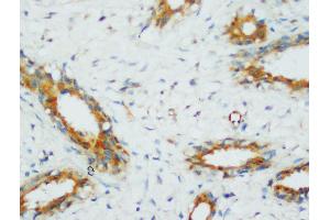 Anti-PP2A antibody, IHC(P) IHC(P): Human Mammary Cancer Tissue