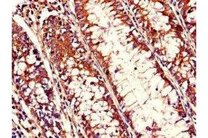 Immunohistochemistry of paraffin-embedded human colon cancer using ABIN7168038 at dilution of 1:100 (RHOH 抗体  (AA 1-188))